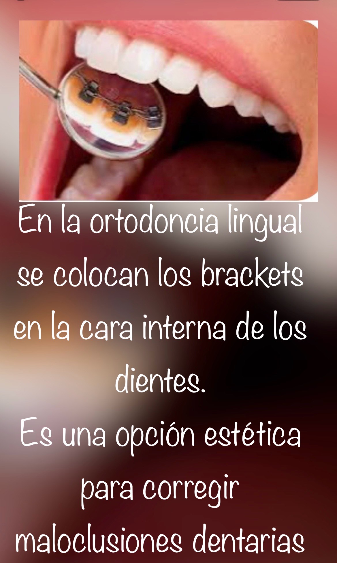 Ortodoncia Lingual detalle
