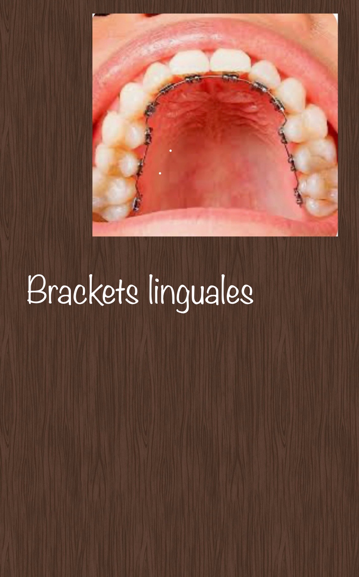 Brackets linguales en boca