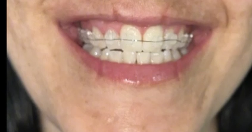 Brackets Estéticos