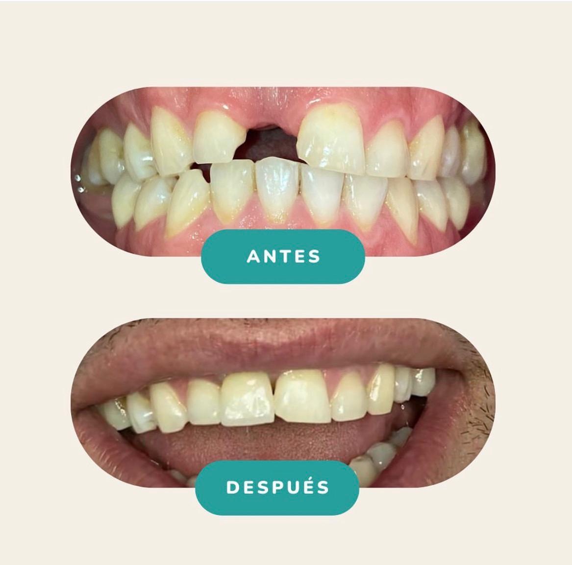 Implantes Dentales